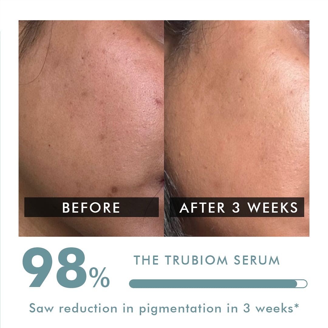 Pigmentation & Dark Spots Treatment | 5% Niacinamide Serum | 30 ml