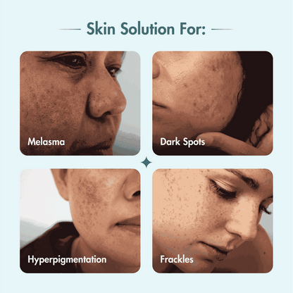 Pigmentation & Dark Spot Corrector Gel Cream | Kojic Acid & Niacinamide | 50 gm