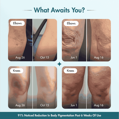 Pigmentation & Dark Spot Corrector Gel Cream | Kojic Acid & Niacinamide | 50 gm