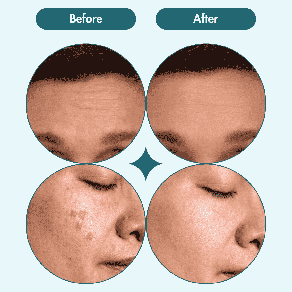 Pigmentation & Dark Spot Corrector Gel Cream | Kojic Acid & Niacinamide | 50 gm